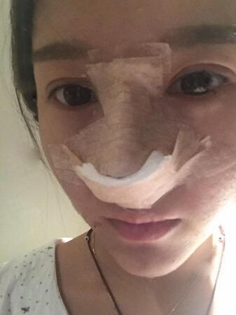 膨体隆鼻2个月恢复日记