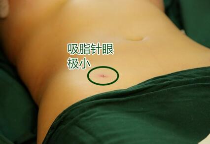 自体脂肪丰胸的恢复2个月