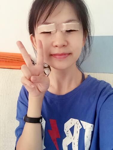 切开双眼皮+开眼角消肿恢复过程图