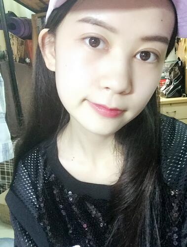 切开双眼皮+开眼角消肿恢复过程图