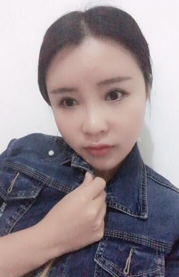 自体脂肪填充全脸恢复经历