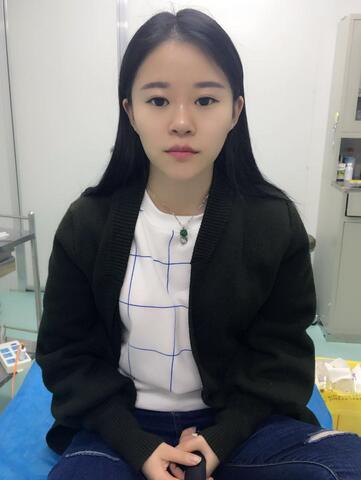 玻尿酸隆鼻恢复过程图