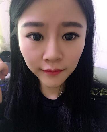 玻尿酸隆鼻恢复过程图