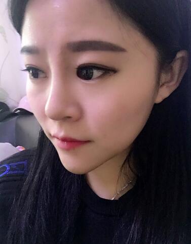 玻尿酸隆鼻恢复过程图