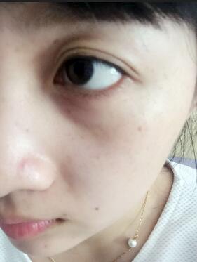 去鱼尾纹的很好方法 注射瘦脸去鱼尾纹果分享