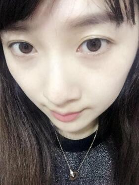 去鱼尾纹的很好方法 注射瘦脸去鱼尾纹果分享