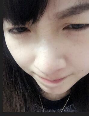 去鱼尾纹的很好方法 注射瘦脸去鱼尾纹果分享