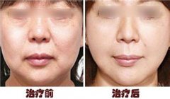 做蛋白线面b提升成好吗、可以保持多久 做蛋白线面b提升成好吗、可以保持多久