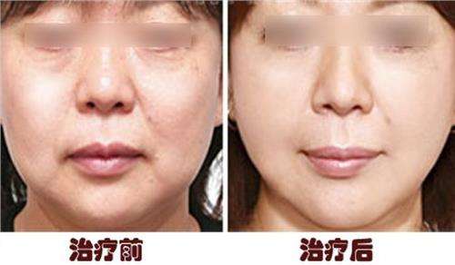做蛋白线面b提升成好吗、可以保持多久
