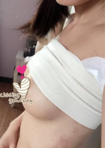 假体隆胸果自然吗 假体隆胸亲身经历