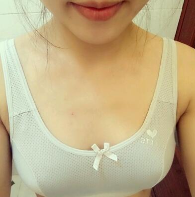 自体脂肪丰胸后十天图