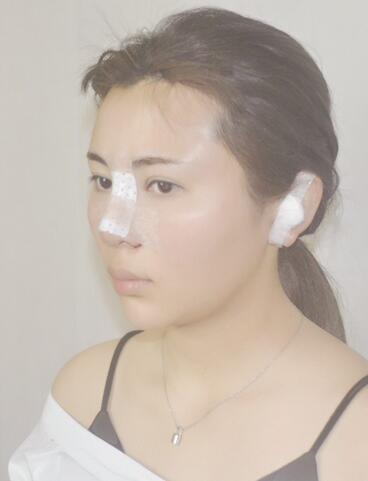 韩式生科三段隆鼻术后恢复经历
