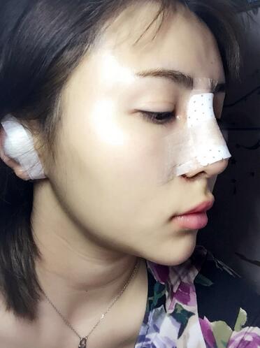 韩式生科三段隆鼻术后恢复经历