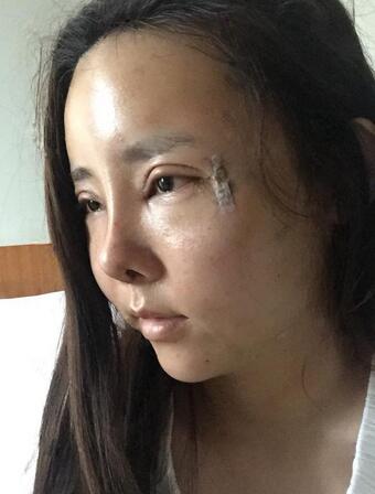 自体脂肪填充+双眼皮多项整形+隆鼻整形3个月恢复日记
