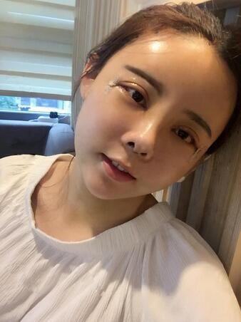 自体脂肪填充+双眼皮多项整形+隆鼻整形3个月恢复日记