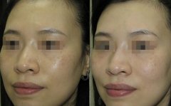 激光嫩肤有果吗、激光嫩肤能保持多久
