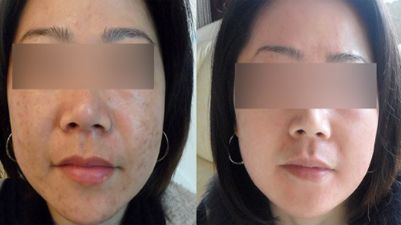 激光嫩肤有果吗、激光嫩肤能保持多久