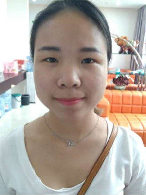 广州广美做的假体隆鼻，给大家分享一下手术前后过程以及对比照片