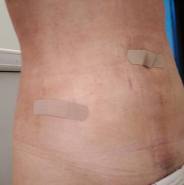 腰腹抽脂3个月的感受