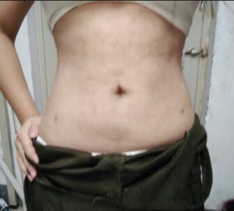 腰腹抽脂3个月的感受