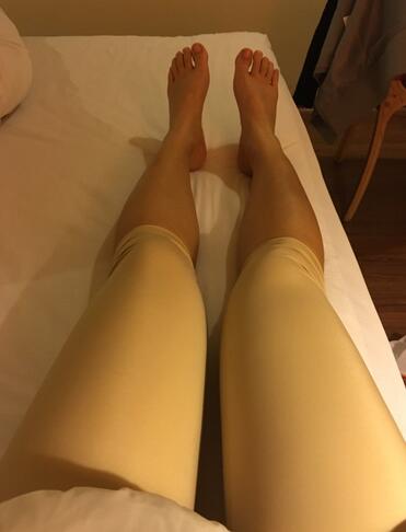 重庆好美自体脂肪隆胸已经一个月了