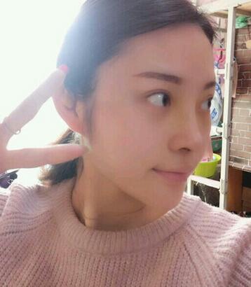 隆鼻整形1个月真实恢复期图片