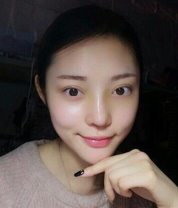 隆鼻整形1个月真实恢复期图片