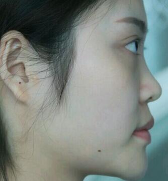 隆鼻整形1个月真实恢复期图片