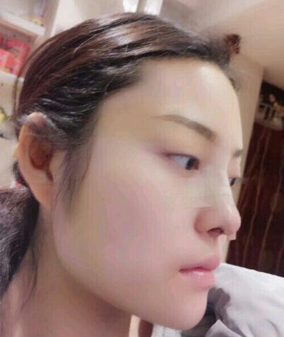 隆鼻整形1个月真实恢复期图片
