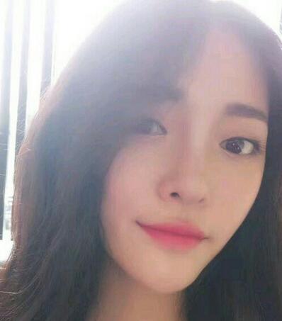 隆鼻整形1个月真实恢复期图片