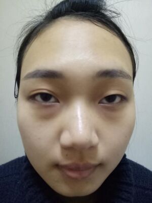 全切双眼皮修复成功案例分享~