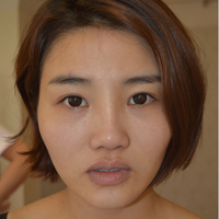 自体脂肪面部填充恢复日记分享，丰了额头和苹果肌