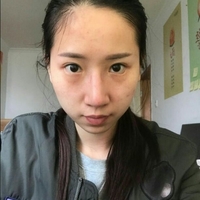 在西安爱丁做的自体脂肪面部填充真实整形恢复过程图