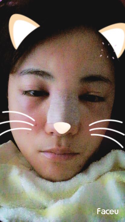 鼻子做完假体12天恢复图