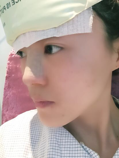 鼻子做完假体12天恢复图