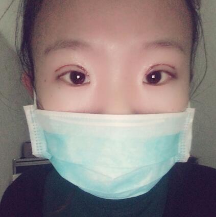 割双眼皮术后恢复过程 全切双眼皮3个月