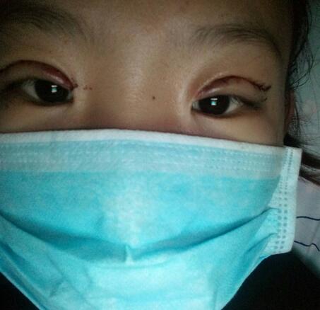 割双眼皮术后恢复过程 全切双眼皮3个月