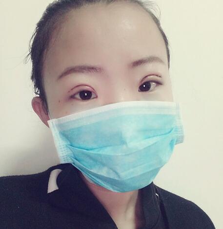 割双眼皮术后恢复过程 全切双眼皮3个月