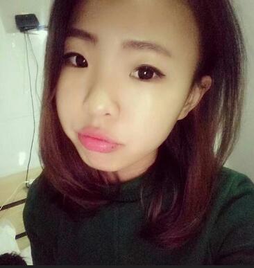 割双眼皮术后恢复过程 全切双眼皮3个月