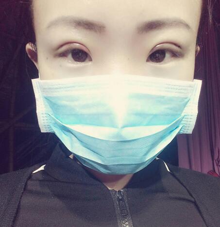 割双眼皮术后恢复过程 全切双眼皮3个月