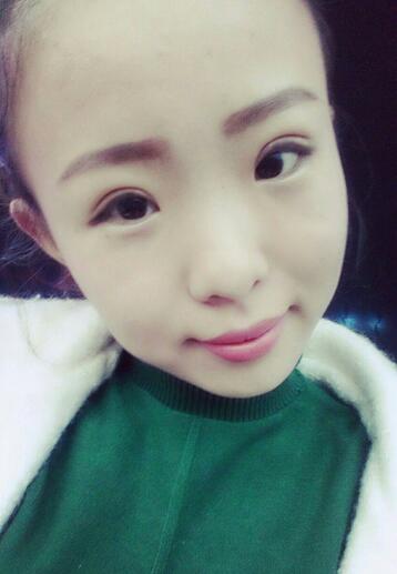 割双眼皮术后恢复过程 全切双眼皮3个月