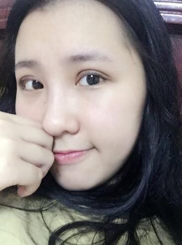 切的双眼皮90天恢复过程图