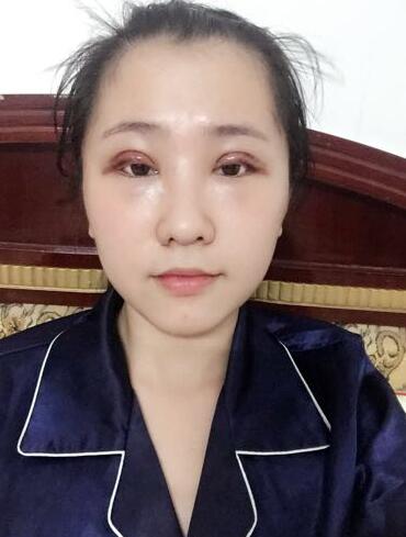 切的双眼皮90天恢复过程图