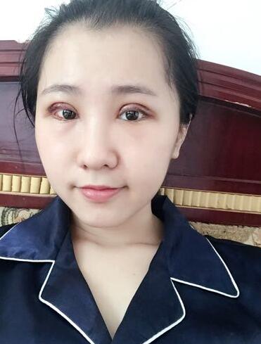 切的双眼皮90天恢复过程图
