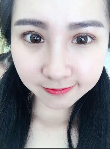 切的双眼皮90天恢复过程图