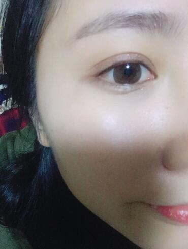 切的双眼皮90天恢复过程图