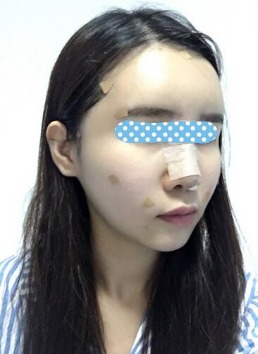 自体脂肪填充后2个月图