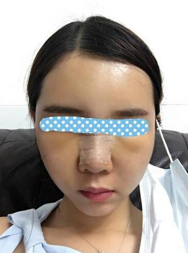 自体脂肪填充后2个月图