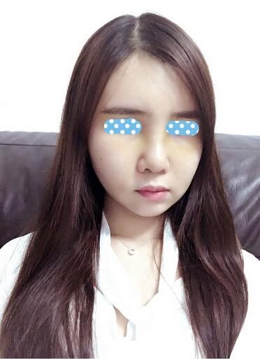 自体脂肪填充后2个月图