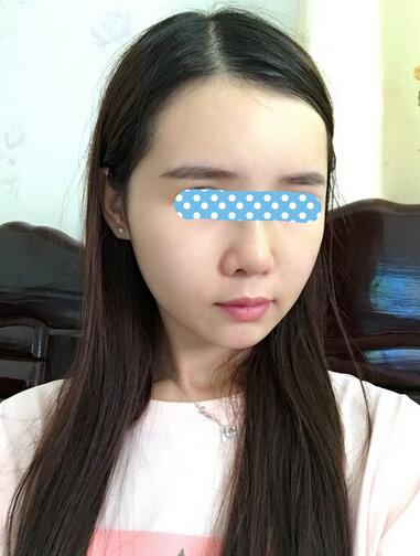 自体脂肪填充后2个月图